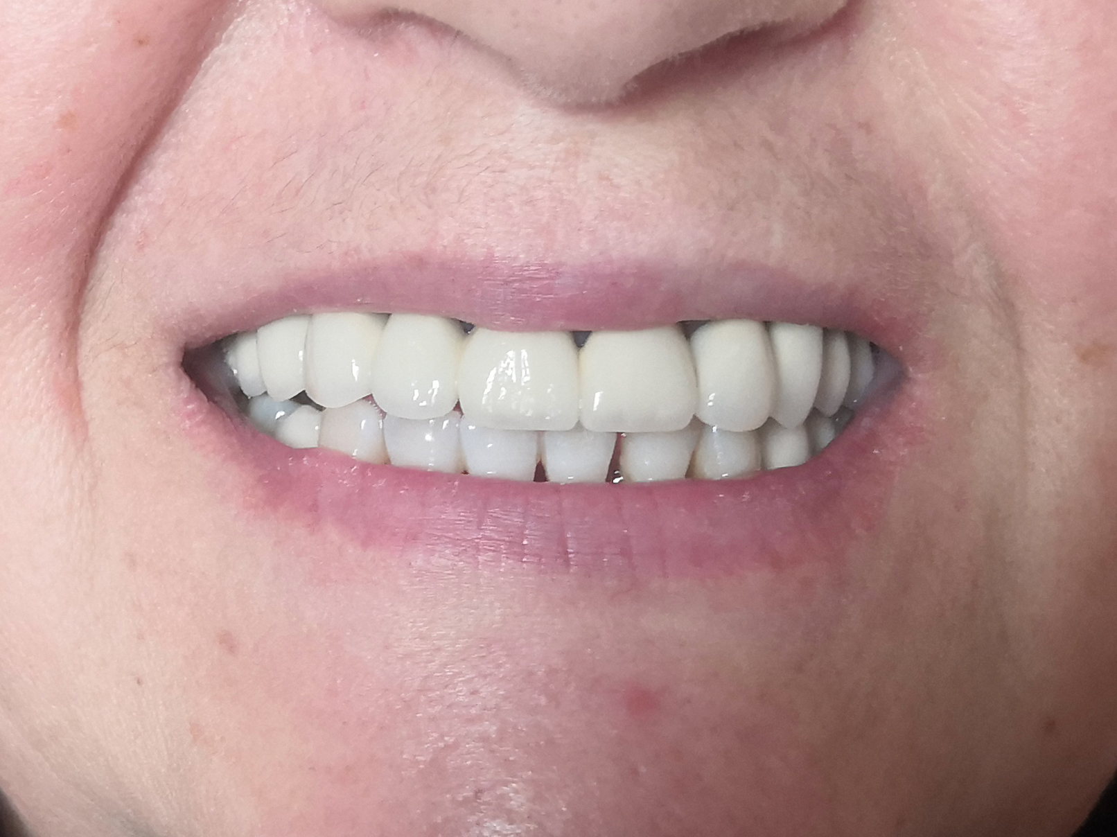 Після відбілювання зубів, Стоматологія Royal Dental