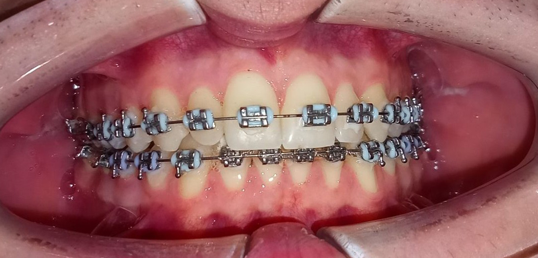 Після відбілювання зубів, Стоматологія Royal Dental